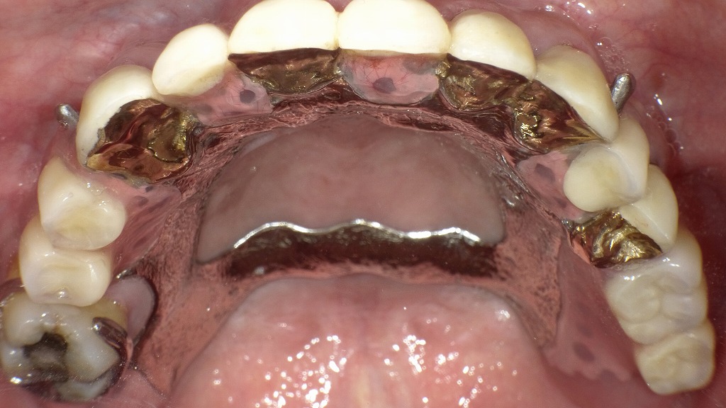 コーヌス義歯咬合面観