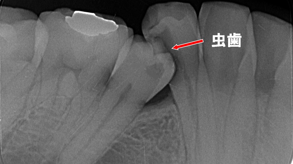 半埋伏の5番が隣の4番に食い込み、磨けない部分に虫歯ができた典型例です。