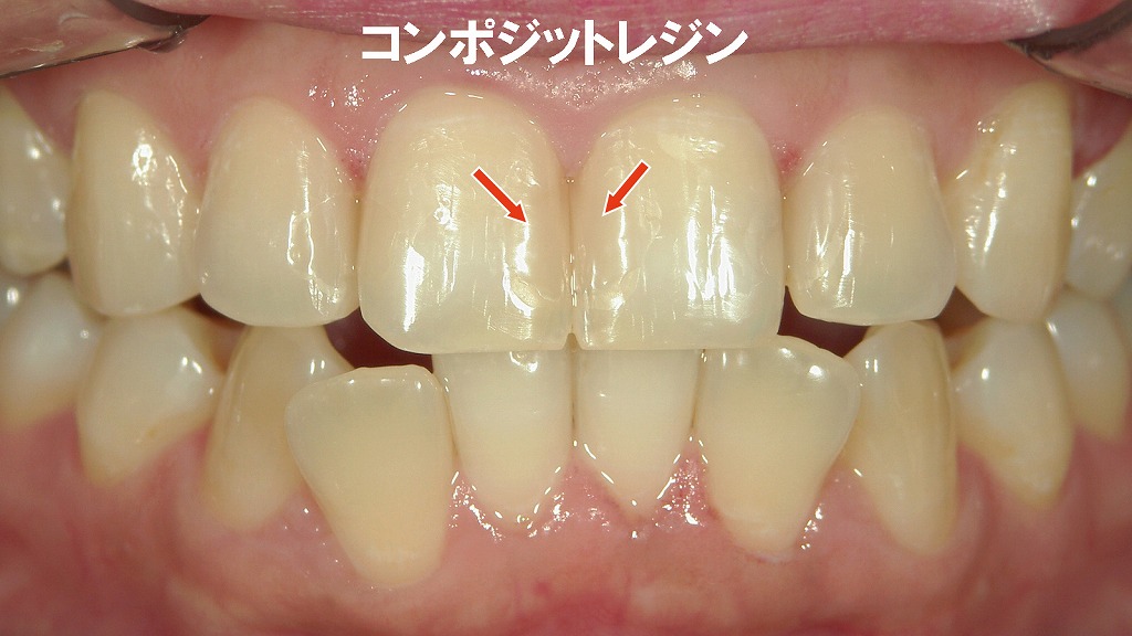 ホームホワイトニング前