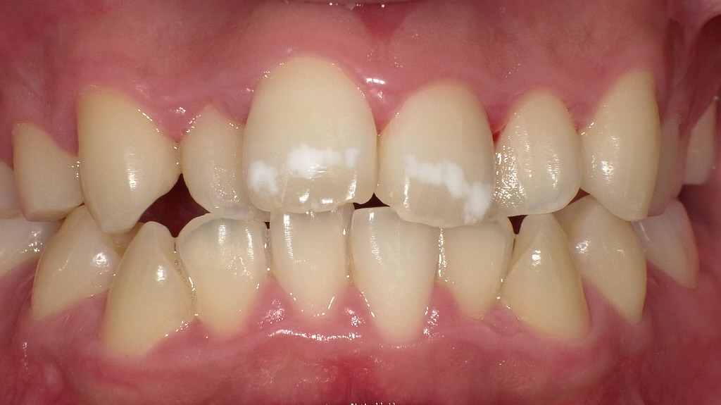 ホワイトスポットが目立つ前歯の状態（治療前）