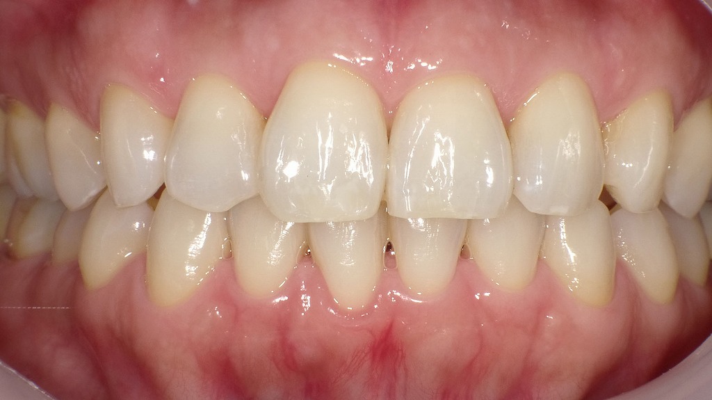 アイコン(ICON)治療後の状態です。