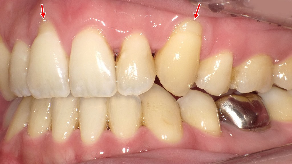 歯ぐき下がりが原因の知覚過敏