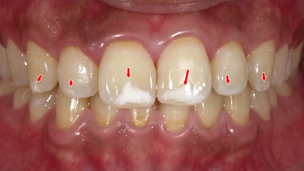 エナメル質形成不全によるホワイトスポットの典型例