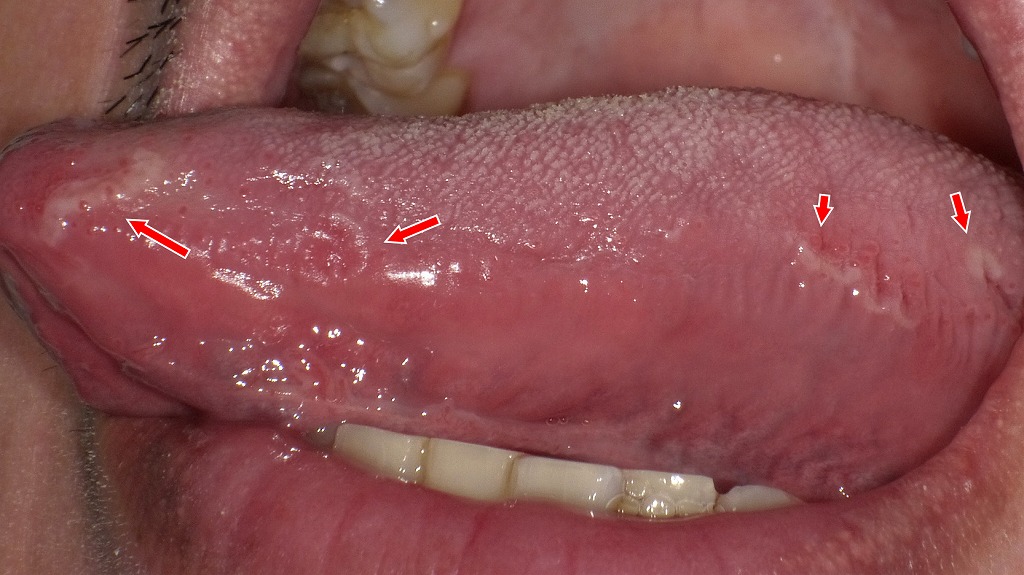 左側舌縁に複数の紅斑と白色縁取りが帯状に分布する地図状舌の所見。