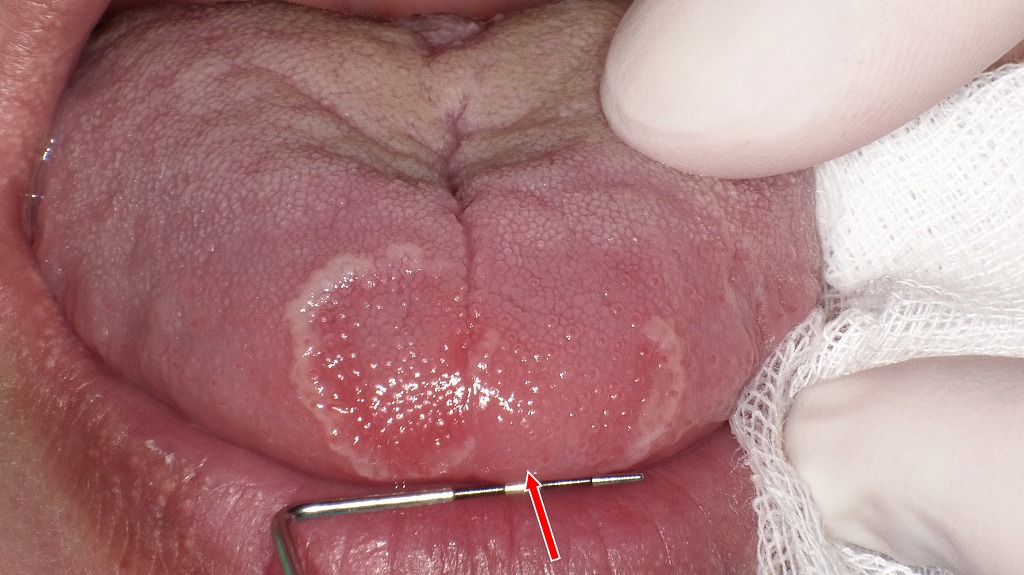 舌尖部に境界明瞭な紅斑と白色辺縁がみられる典型的な地図状舌。