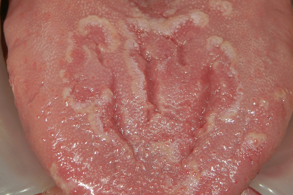 舌の表面に地図のような赤い斑点と白い縁取りが現れる「地図状舌」の典型例。場所や形が日によって変化しますが、ほとんどが良性で心配のない状態です。