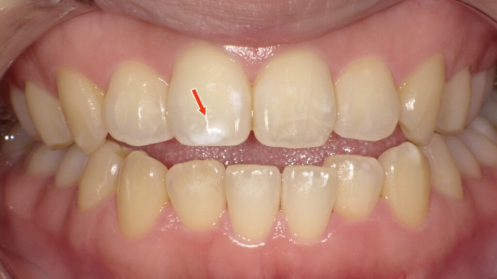 １枚目：ホワイトニング前