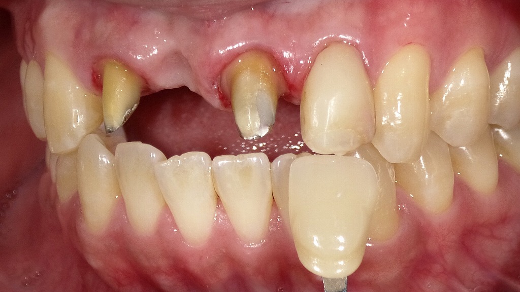 前歯の土台（コア）形成と最終印象に向けた準備