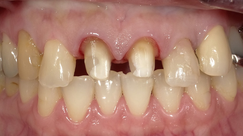 前歯にファイバーコアで土台を築造し、被せ物のための安定した基盤を整えた状態です。