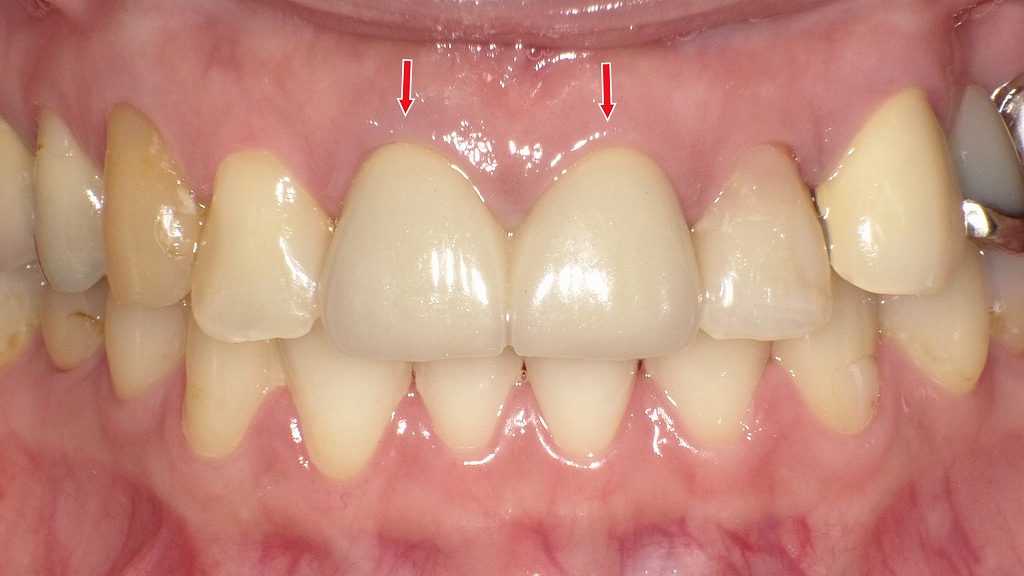セラミッククラウンを装着し、自然な色調と形態で前歯の審美性を回復した状態です。