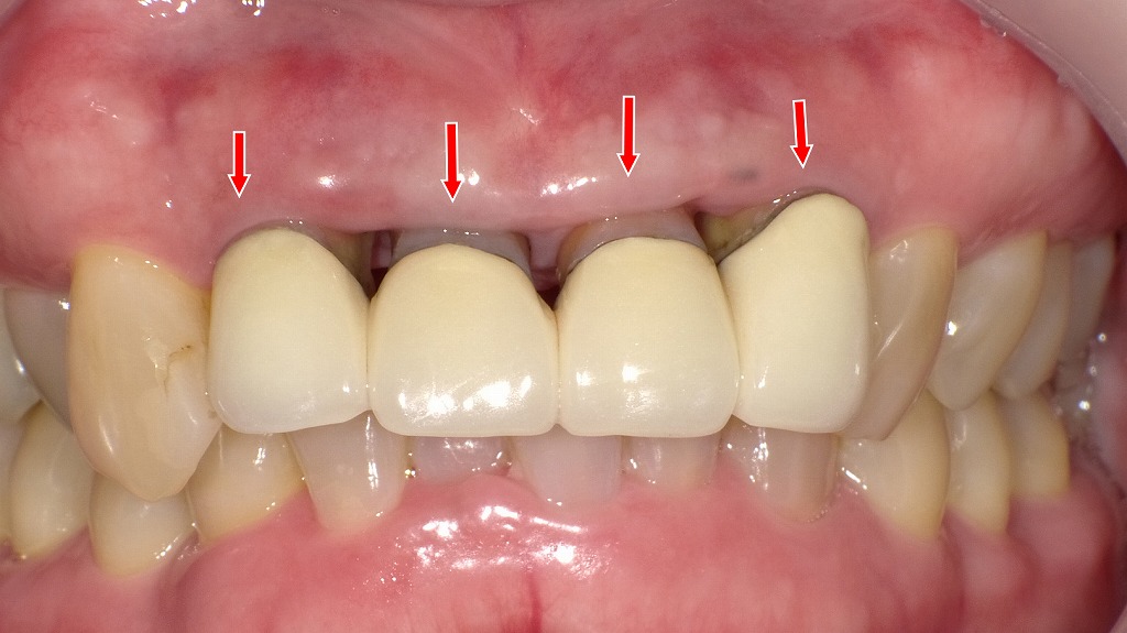 歯肉退縮による黒い歯根の露出