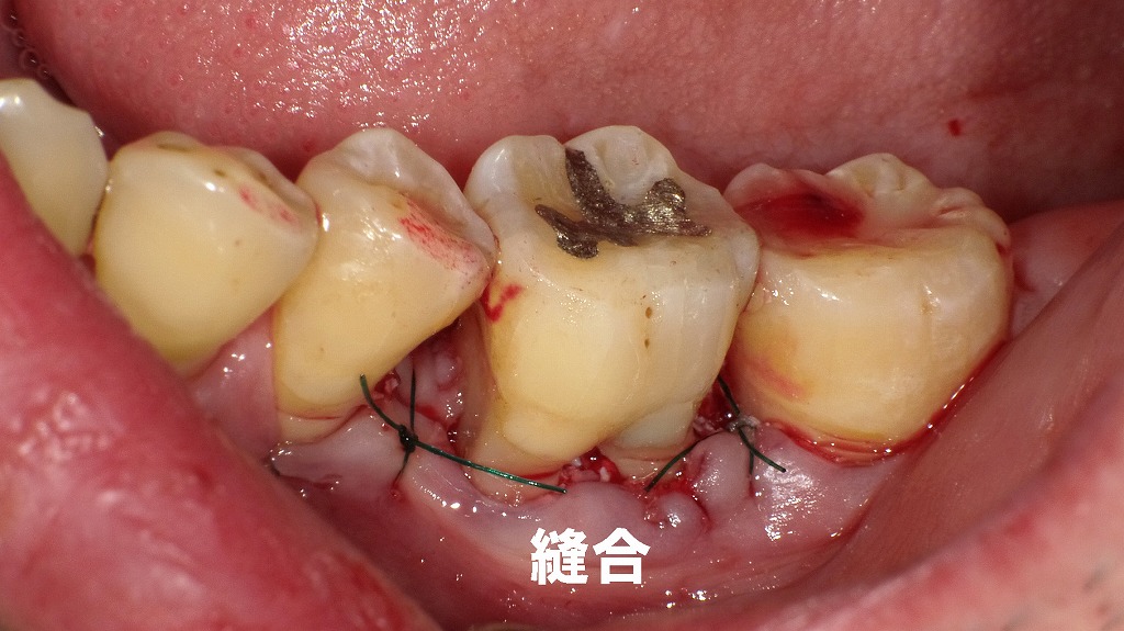 歯肉縫合