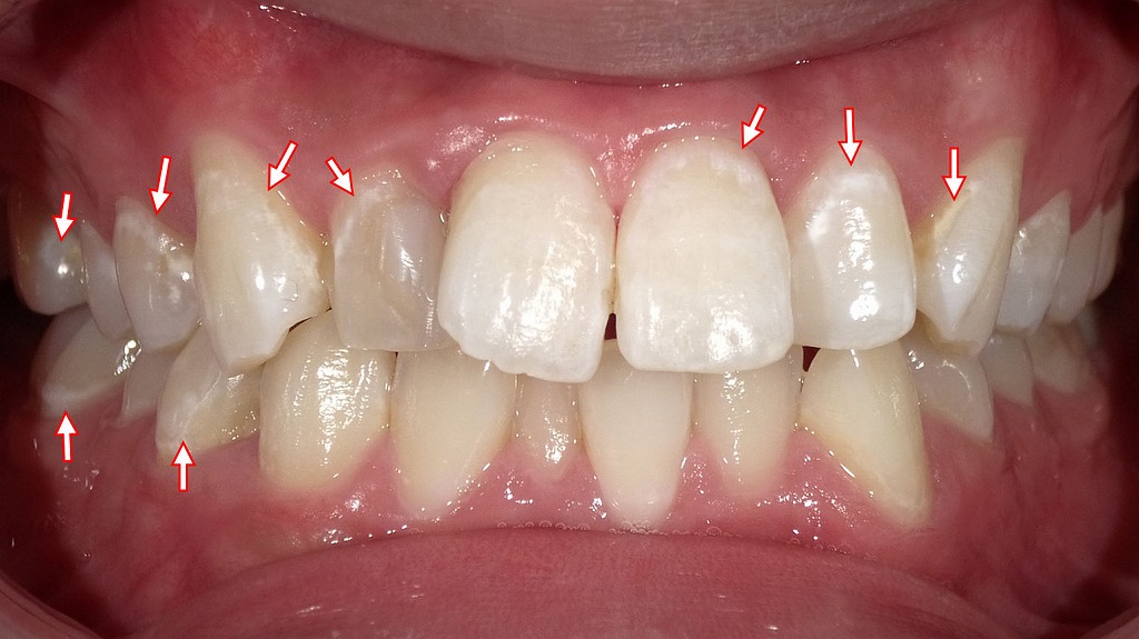 2枚目：ホワイトニング後