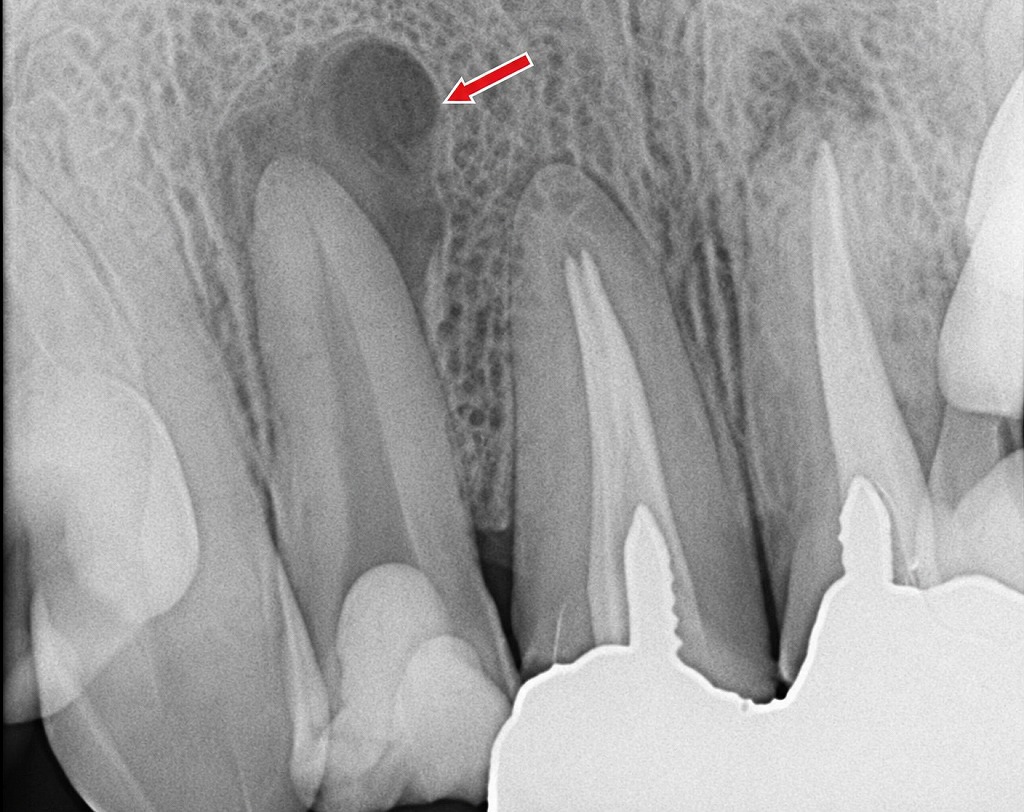 歯ぐきがジンジン痛む原因｜歯根の膿と根管治療が必要なケース