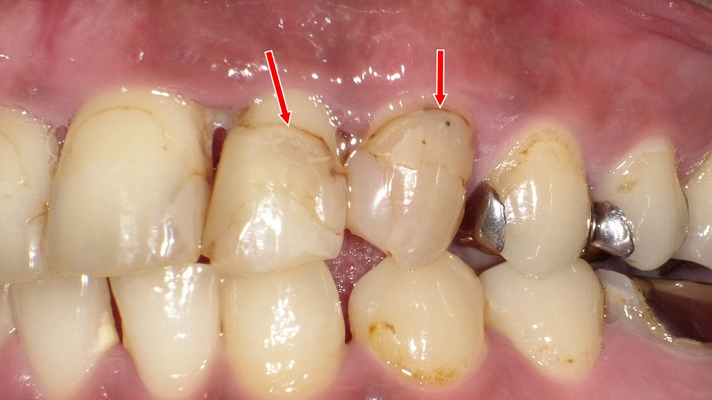 詰め物（レジン）の境目に着色が入り、茶色く見えている状態です。
