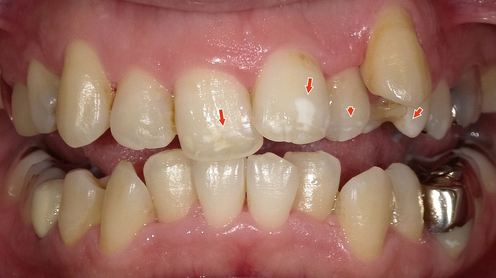 1枚目の画像:術前