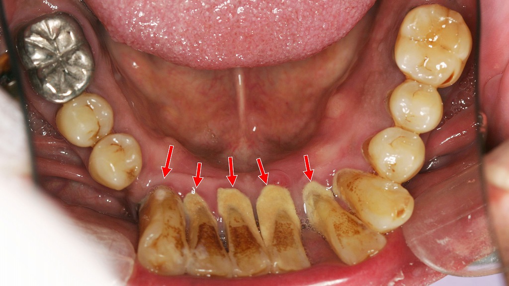 下顎前歯の舌側に大量の歯石が付着し、重度歯周病のフレアアウト症例