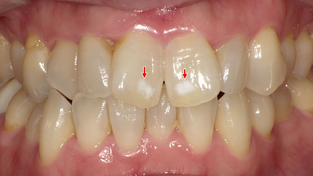 ホワイトニング後の前歯|ホワイトスポットが強調された状態
