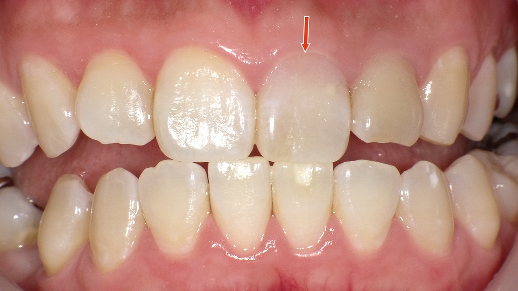 ホワイトニング後の口腔内写真