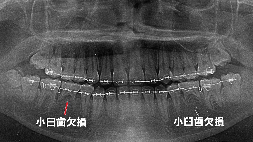 先天欠損した第二小臼歯を考慮して行う矯正治療のレントゲン