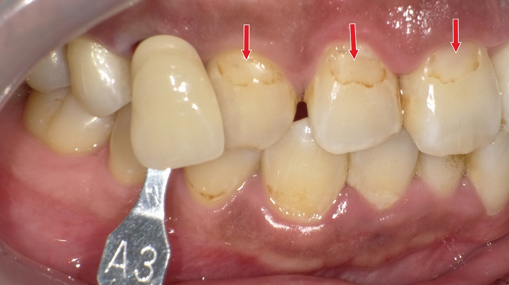 コンポジットレジンの経年劣化による変色例：色調不一致と辺縁部のステイン
