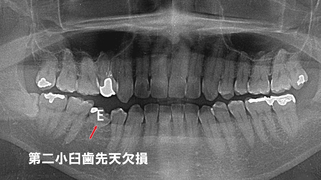 小臼歯の先天欠損が引き起こす前歯スペースと咬合異常の可能性がある症例