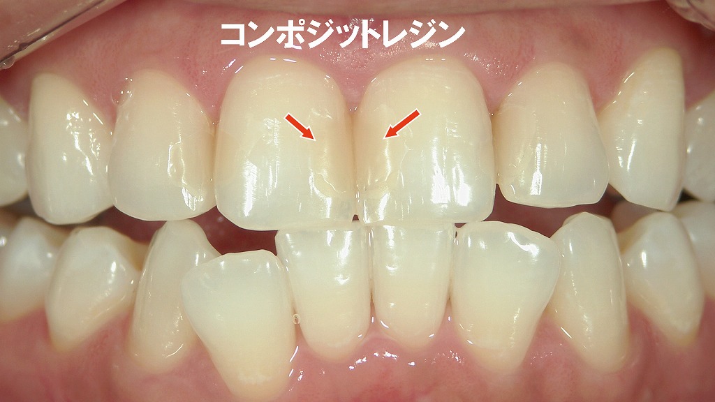 ホームホワイトニング後