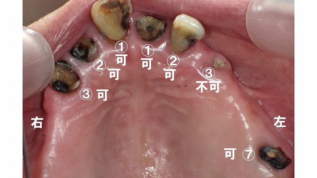 上顎咬合面観による詳細評価と保存可能歯の判定