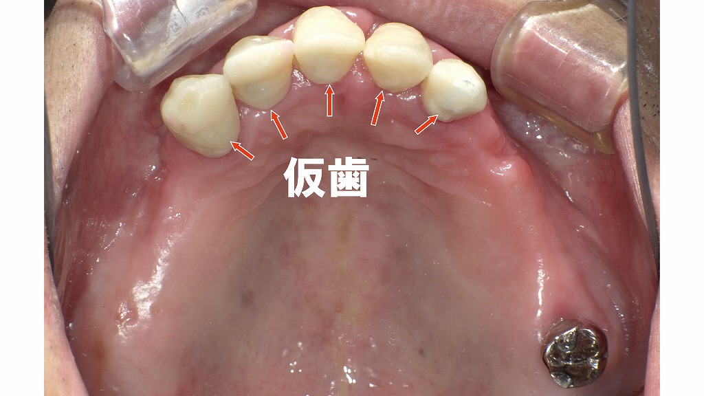 . 前歯部仮歯(プロビジョナルクラウン)による審美・機能評価
