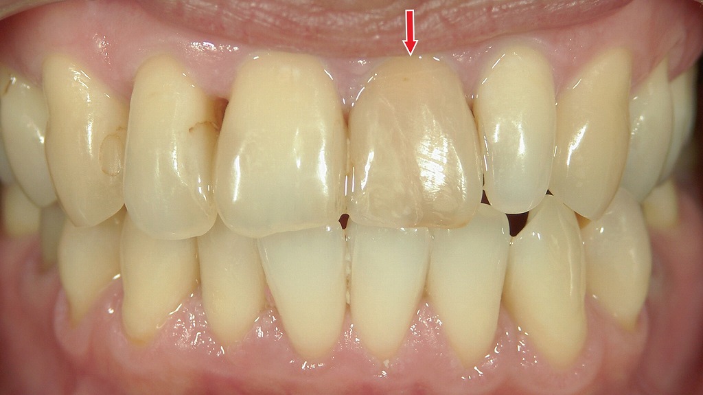 術前：全体的に黄ばみがあり、失活歯も周囲と同じように暗く見えます。