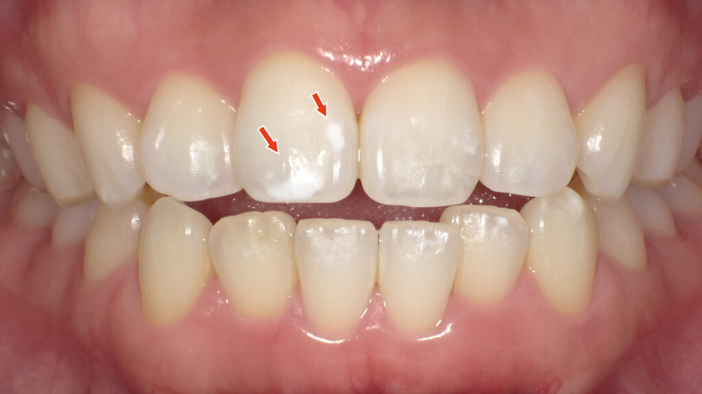 ２枚目：ホワイトニング後