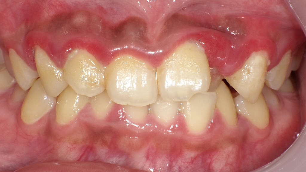 正面写真(初診時):歯茎全体の腫れと発赤が強くみられた状態