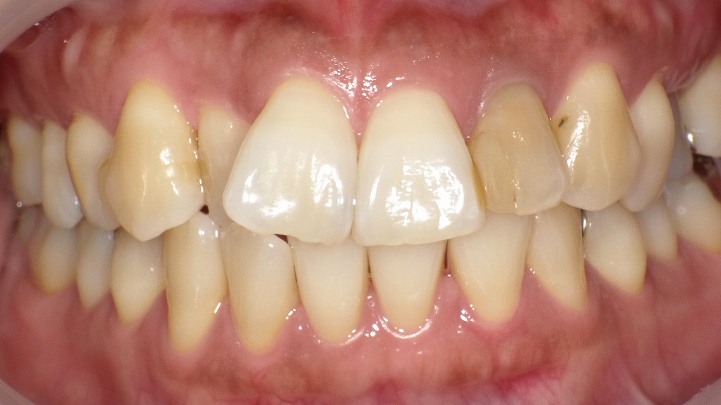 前歯2本が大きく見える主因となっている中切歯の形態差（正面観）