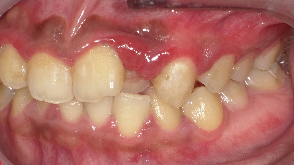 左側面写真(初診時):2番の歯肉腫脹が顕著