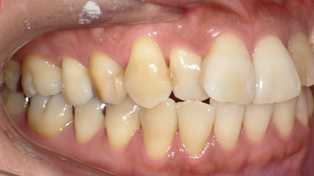 突出した前歯の位置とバランスを確認する右側面観