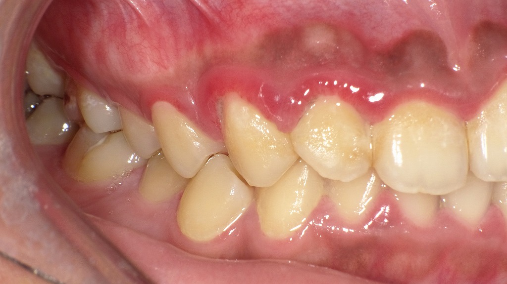 右側面写真(初診時):歯垢・歯石の付着による歯茎の腫れ