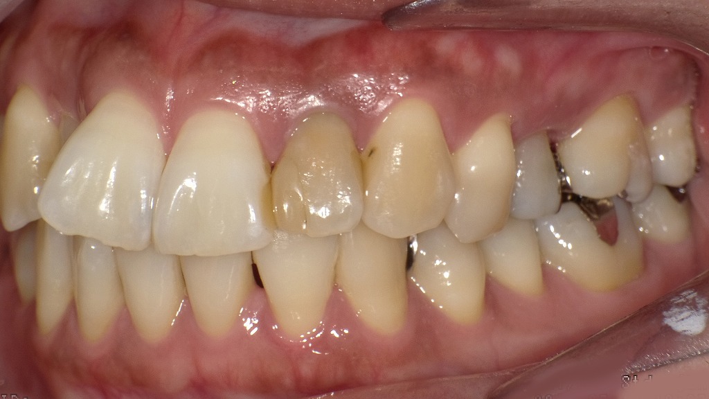 変色した左上2番（失活歯）と中切歯との形態差（左側面観）