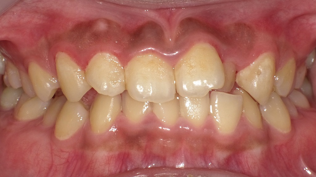 正面写真(術後1か月後):腫れが引き、歯茎の輪郭が明瞭になった状態
