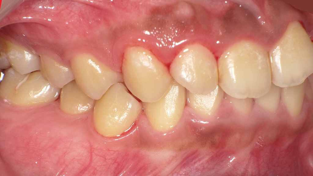 右側面写真(術後1か月後):プラーク除去により炎症が改善した右側歯肉