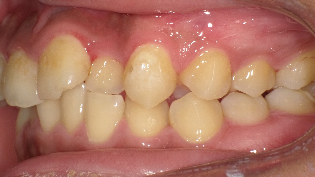 左側面写真(術後1か月後):歯茎の発赤が軽減し、健康的な色調を取り戻した左側