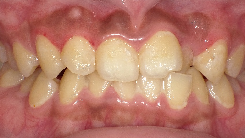 正面写真(術後3か月後):下顎前歯のプラークコントロール不良が顕著