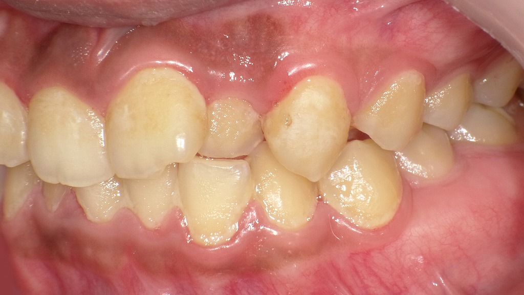 左側面写真(術後3か月後):歯茎の発赤腫脹が再発