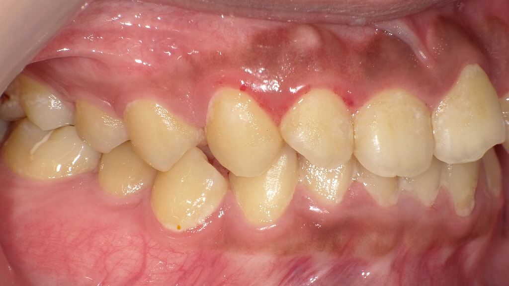 右側面写真(術後3か月後):歯肉縁付近にプラークが再沈着