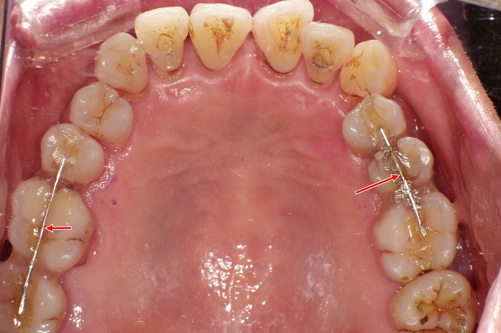 重度歯周病治療後の上顎咬合面観｜臼歯部動揺に対するワイヤー併用暫間固定