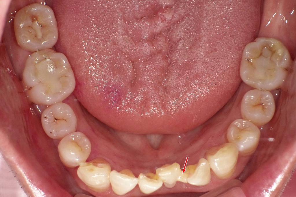 重度歯周病治療後の下顎咬合面観｜前歯部のみの暫間固定