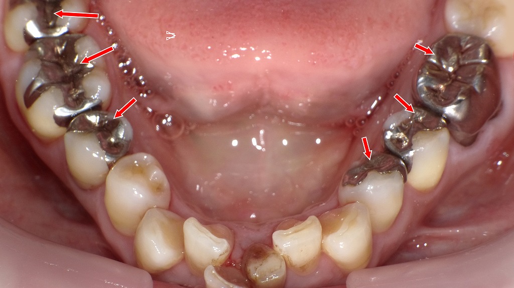 銀歯の詰め物・被せ物