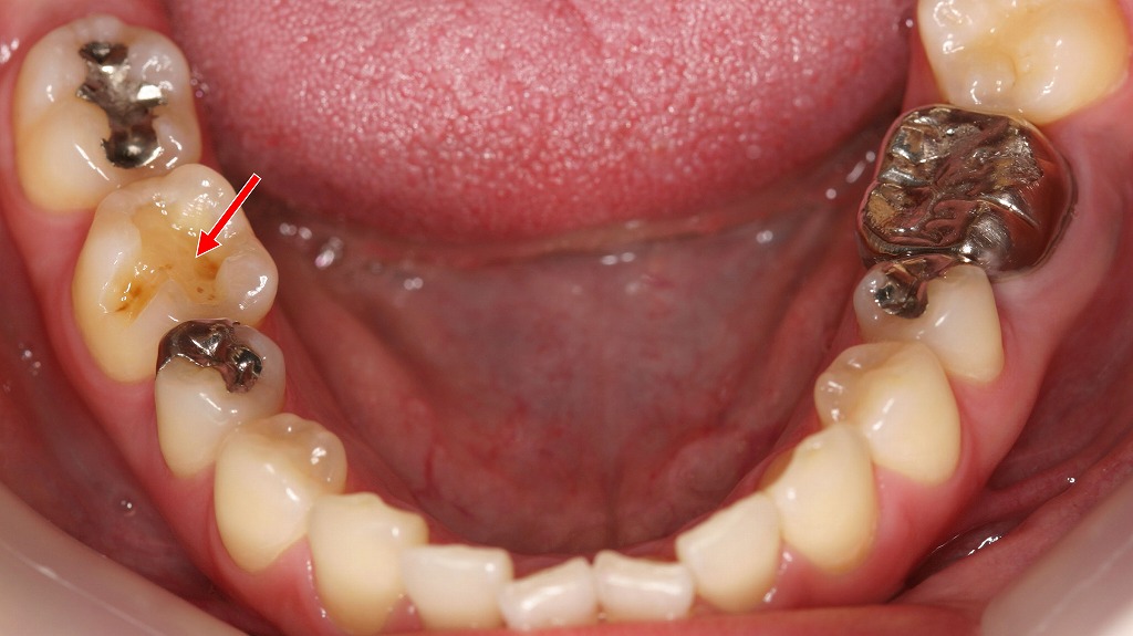 インレー脱離による二次的トラブルのリスク