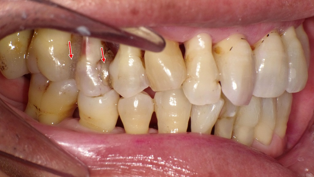 重度歯周病治療後の左側面所見｜上顎臼歯部T-FIXによる暫間固定