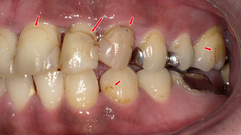 コンポジットレジン充填の欠点：経年劣化・着色・境界部分が変色するリスク