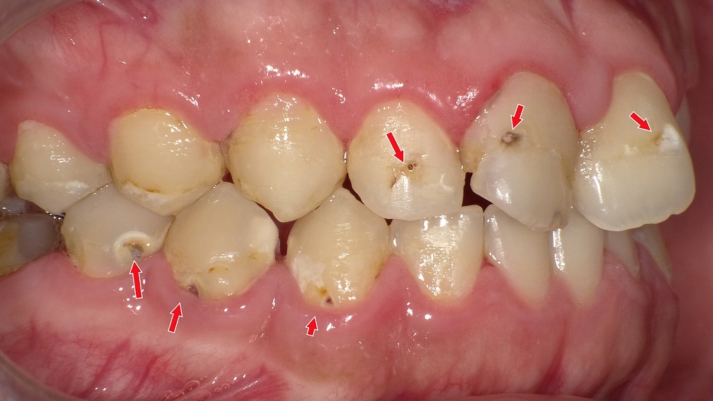下顎4・5番に象牙質まで進行した虫歯(C2)|他部位は初期虫歯(C1)の段階